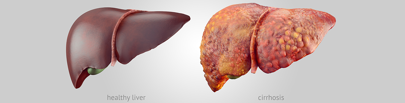 Cirrhosis: What is scarring your liver? | Sanar Hospital