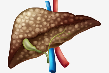 Liver Cirrhosis and some lesser-known facts about it