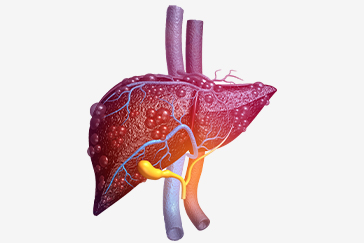 Liver Cirrhosis: What it means and how it affects you