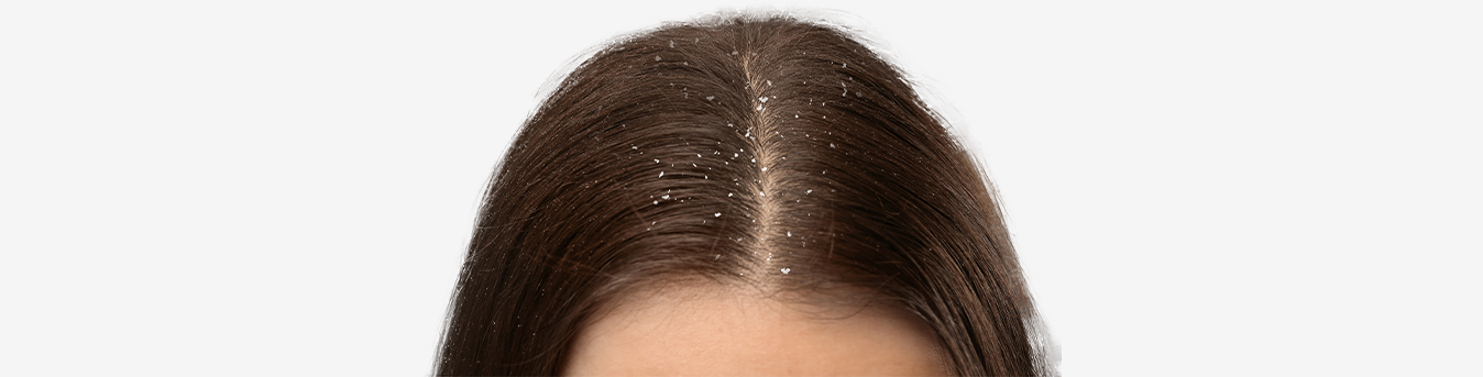 Snowflakes or Dandruff flakes: Make your scalp healthier this winter