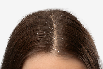 Snowflakes or Dandruff flakes: Make your scalp healthier this winter