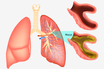 Bronchitis: What it means and how you can manage it at home?