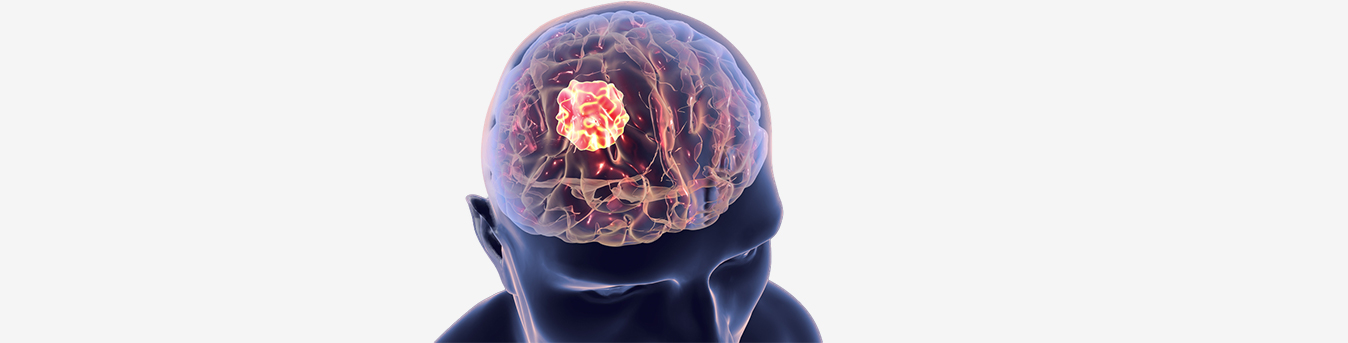 Brain Tumour symptoms that should not be overlooked