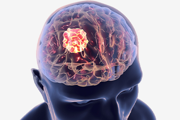 Brain Tumour symptoms that should not be overlooked
